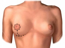 Anchor Incision